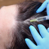 Anti hair loss injection in clinic